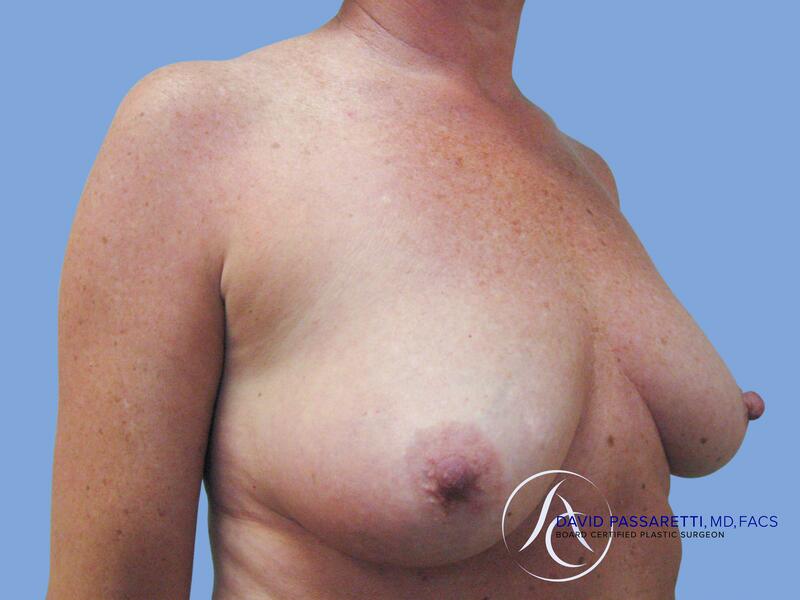 Breast lift before & after photo